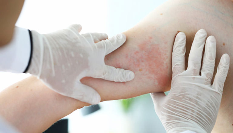 Chàm Eczema dạng viêm da dị ứng là thể bệnh phổ biến nhất tại Việt Nam với tỷ lệ mắc cao