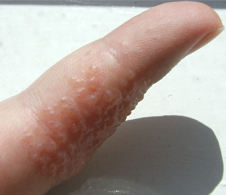 Bệnh tổ đỉa là một dạng viêm da phổ biến và là thể đặc biệt của bệnh chàm – Eczema