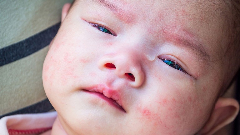 Trẻ sơ sinh bị viêm da cơ địa với đặc điểm nhận biết là những đốm mẩn đỏ nổi nhiều trên mặt, hai má…