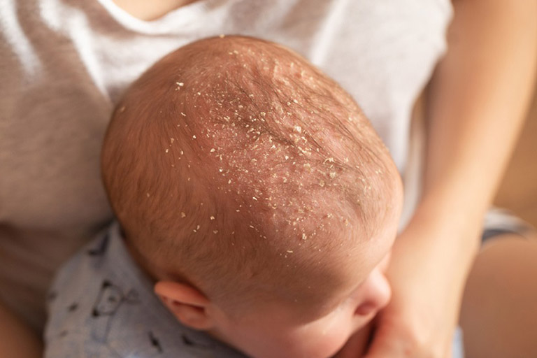 Tình trạng viêm da dầu ở trẻ nhỏ thường xuất hiện trong giai đoạn từ 0 – 3 tháng tuổi và tự biến mất sau đó mà không cần điều trị