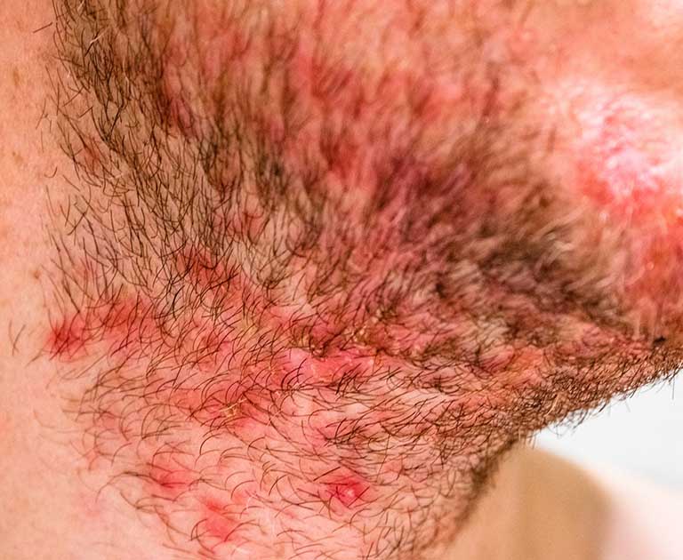Viêm da dầu là bệnh lý da liễu phổ biến đặc trưng triệu chứng là các mảng da đỏ, bong tróc vảy và nhờn dính