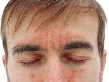 Bệnh viêm da dầu ở người lớn thường xảy ra ở nhiều vị trí như da đầu, mặt, mũi, má, tai… thậm chí là cơ quan sinh dục