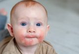 Bé sơ sinh bị nổi mẩn đỏ ở mặt là bệnh gì? Nguy hiểm không?