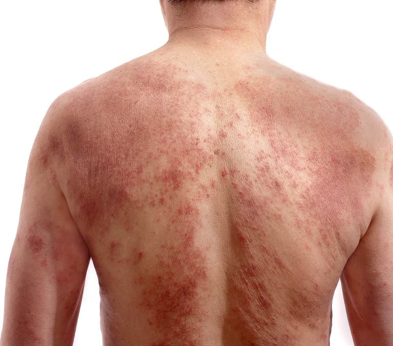Bệnh chàm eczema có chữa khỏi được không?