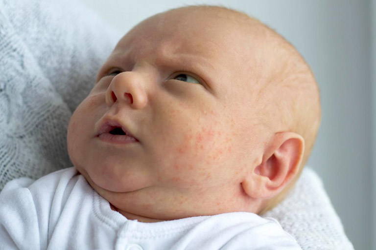 Bệnh eczema ở trẻ sơ sinh