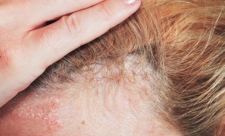 Triệu chứng của bệnh vảy nến da đầu