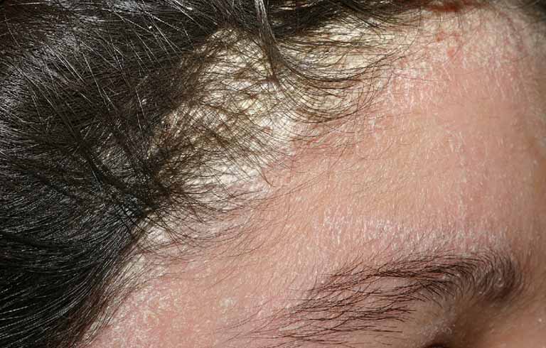 Bệnh vảy nến da đầu là gì? Nguy hiểm không?