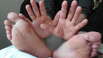 Nổi mẩn đỏ ngứa ở tay và chân: Nguyên nhân và cách điều trị