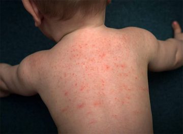 Trẻ bị dị ứng da: Nguyên nhân, cách điều trị và phòng ngừa