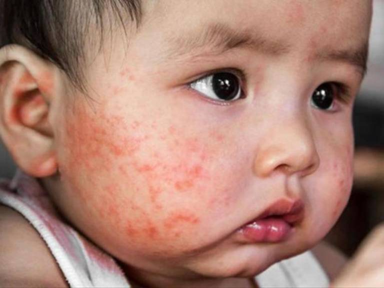 Trẻ bị nổi mẩn đỏ như muỗi đốt khắp người và ngứa nguy hiểm không?