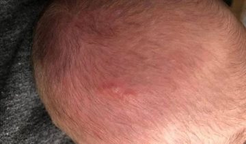 Trẻ sơ sinh bị nổi mẩn đỏ ở da đầu là bệnh gì? Làm sao hết?