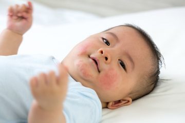 Trẻ sơ sinh bị viêm da dị ứng