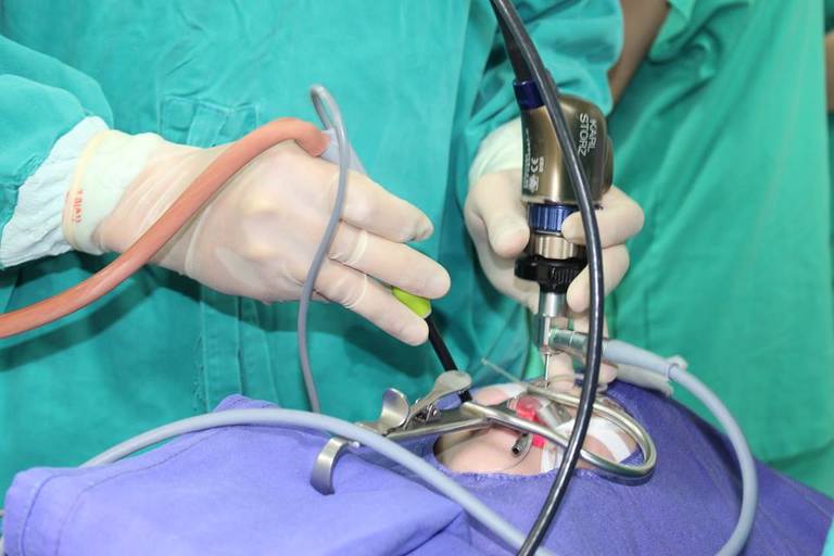 Phẫu thuật cắt amidan 
