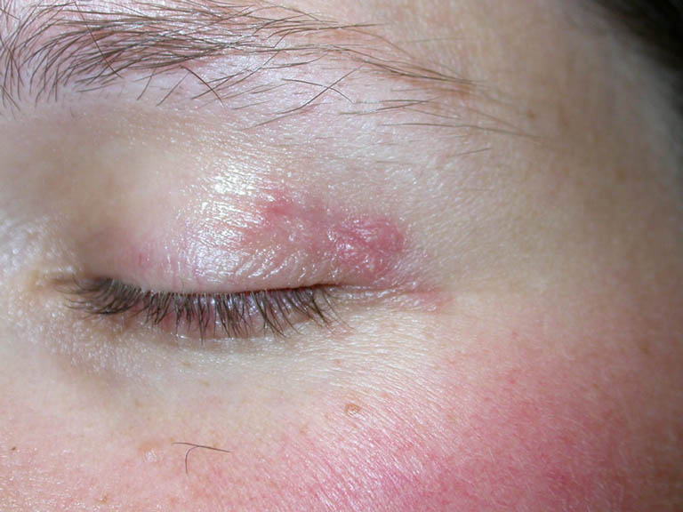 Viêm da tiếp xúc ở mắt