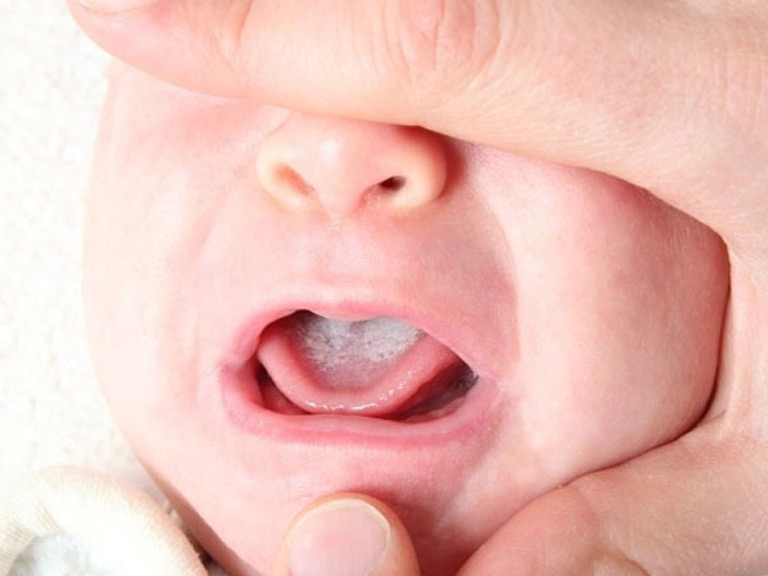 Cách phòng ngừa viêm họng ở trẻ sơ sinh hiệu quả