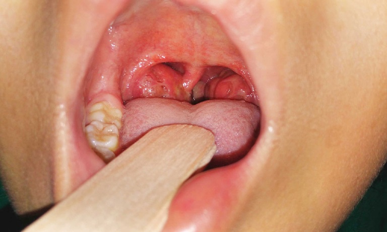 Nguyên nhân gây bệnh viêm amidan lưỡi