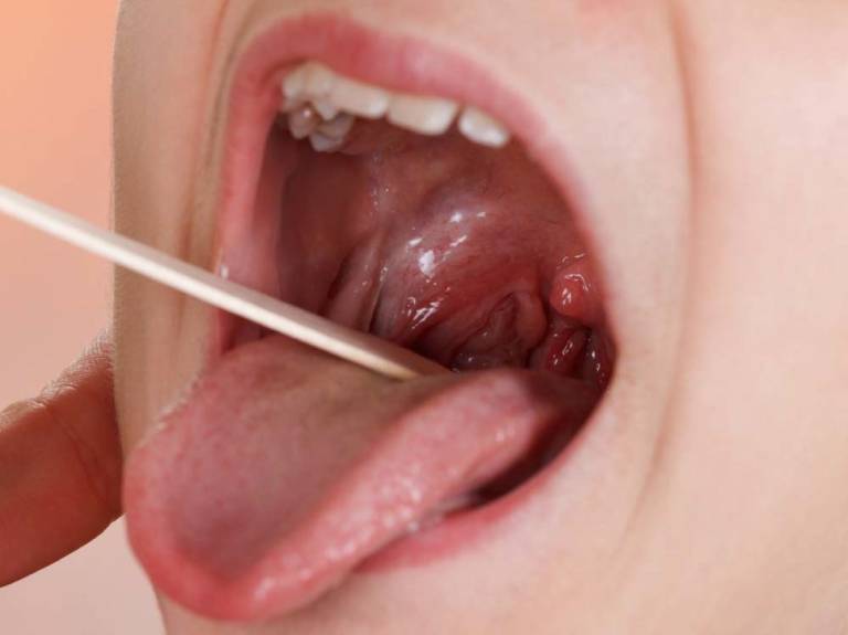 Viêm họng hạt có mủ trắng nguy hiểm không? Cách điều trị
