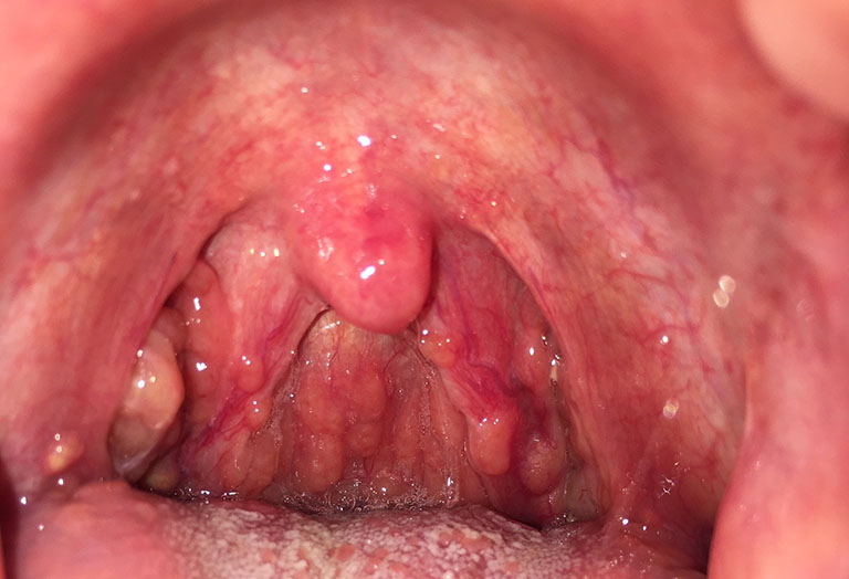Viêm họng hạt mãn tính có nguy hiểm không? 
