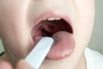 Viêm họng mủ ở trẻ em: Cách chăm sóc và điều trị