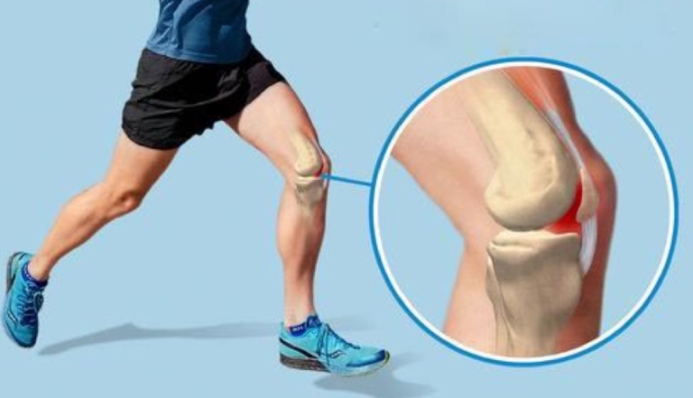 Nguyên nhân gây đau khớp gối khi chạy bộ