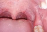 Đau vòm họng trên liên quan đến những bệnh gì?
