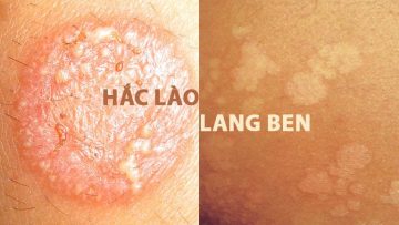 Hắc Lào - Lang Ben: Phân Biệt Và Cách Điều Trị Bệnh