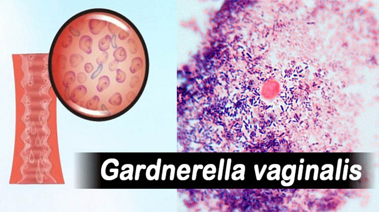 Viêm âm đạo do Gardnerella Vaginalis là gì? Nguy hiểm không?
