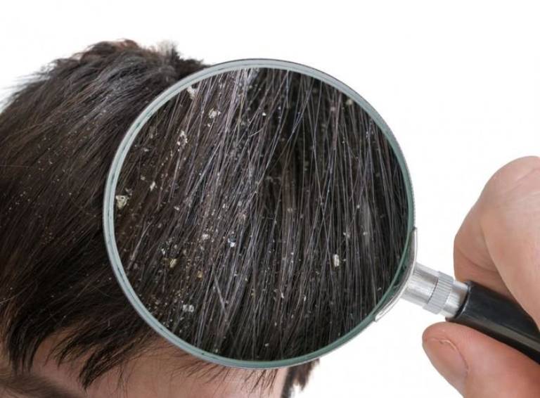 Dấu hiệu phân biệt gàu và nấm da đầu 