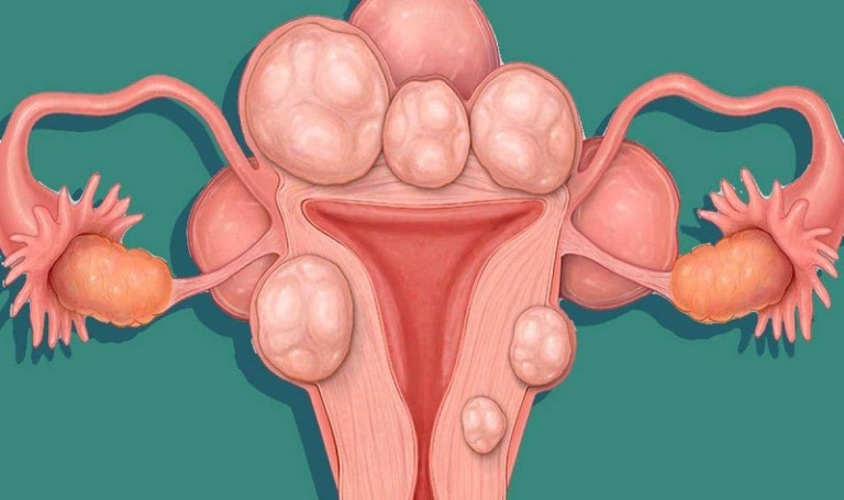 Tìm hiểu về bệnh u xơ tử cung