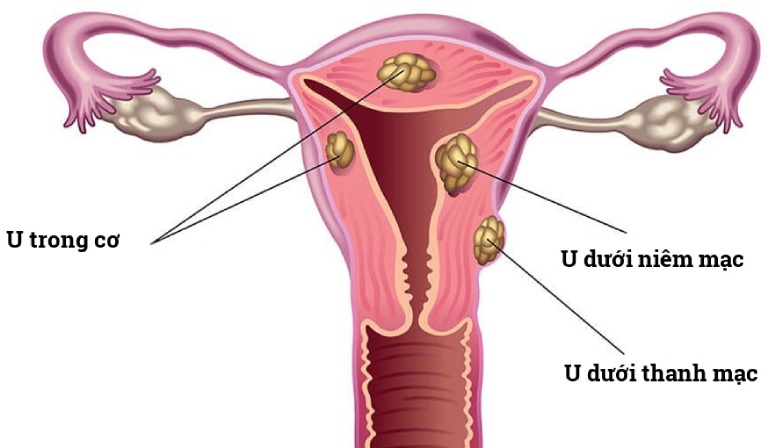 Phân biệt u xơ tử cung và u nang buồng trứng