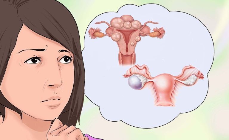 Phân biệt u xơ tử cung và u nang buồng trứng