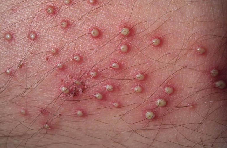 Viêm nhiễm nặng nề gây ra nhiều tổn thương da, nguy cơ lan rộng, vỡ nốt mủ