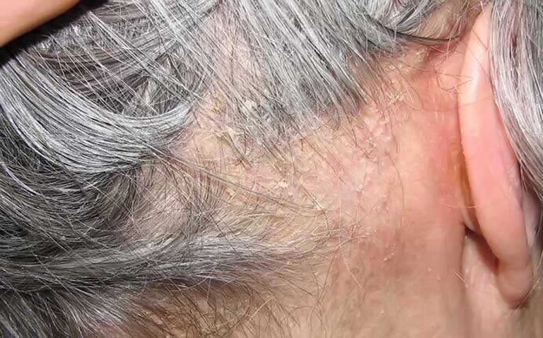 Viêm nang lông da đầu có nguy hiểm không?