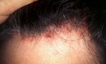 Biểu hiện của viêm nang lông da đầu