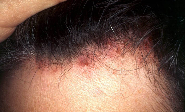 Biểu hiện của viêm nang lông da đầu