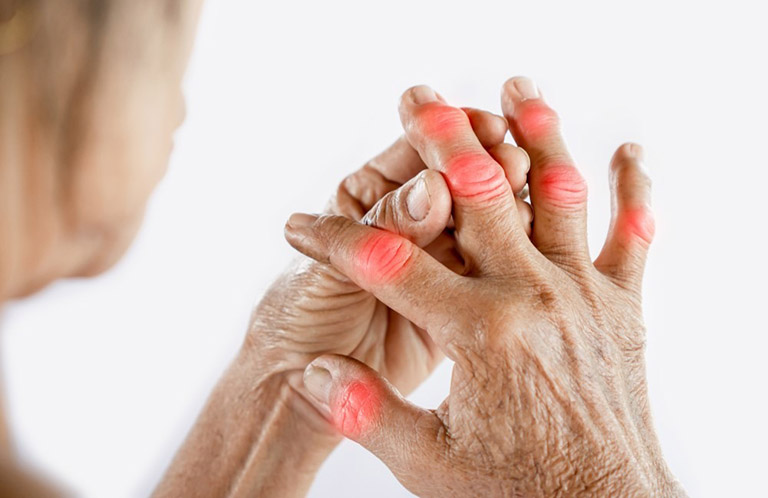 Bất kỳ khớp nào trên cơ thể cũng có khả năng bị viêm, trong đó tình trạng gout ở tay, chân là khá phổ biến