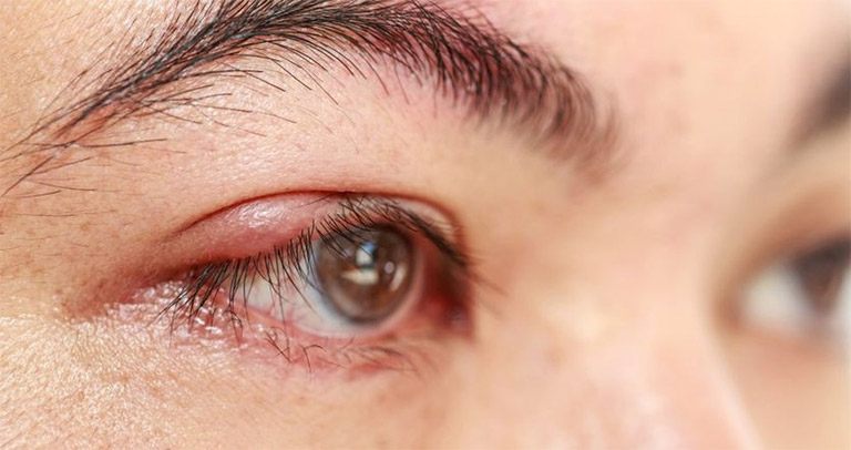 Bấm huyệt Ngư Yêu hỗ trợ điều trị lẹo mắt