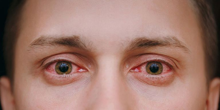 Bấm huyệt Thừa Khấp khoảng 5 - 7 ngày sẽ thấy bệnh mắt đỏ giảm rõ rệt