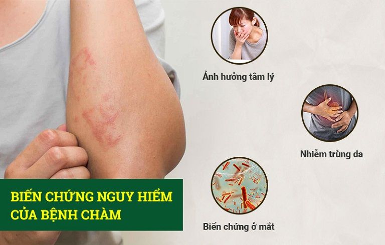 Bệnh chàm Eczema không nguy hiểm nhưng rất khó chữa trị dứt điểm và dễ biến chứng sang các bệnh nhiễm trùng khác