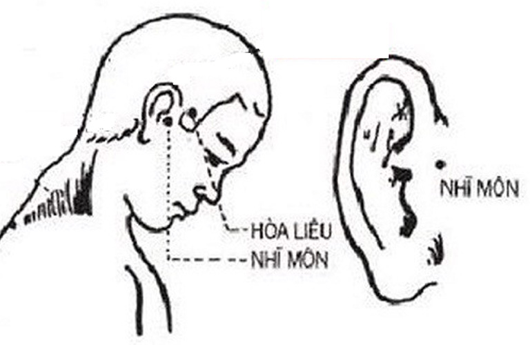 Huyệt Nhĩ Môn nằm trước vành tai, tại chỗ lõm của loa tai
