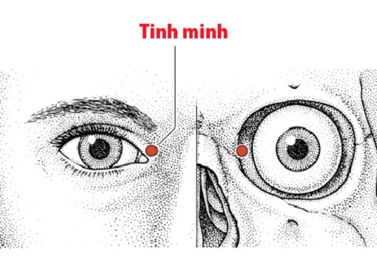 Huyệt Tình Minh cách đầu trong của góc mắt khoảng 0,1 thốn