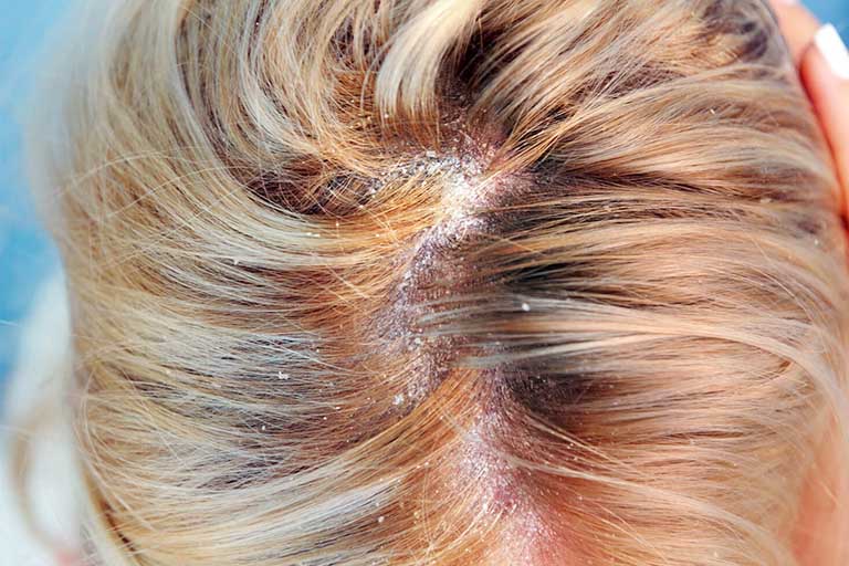 Bệnh nấm da đầu có nhiều triệu chứng phức tạp tùy theo giai đoạn bệnh