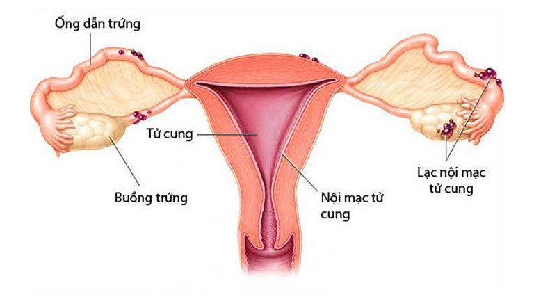 Lạc nội mạc tử cung là bệnh lý các tế bào niêm mạc bị trôi ra ngoài tử cung