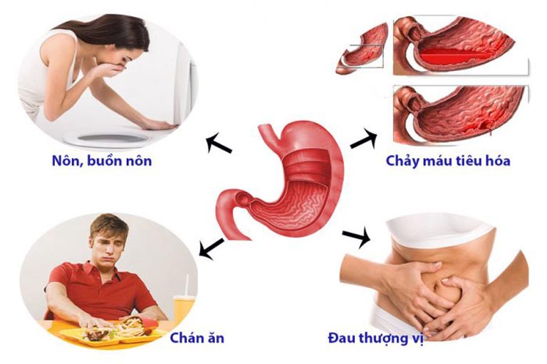 Bệnh dạ dày gây nhiều phiền toái cho người bệnh